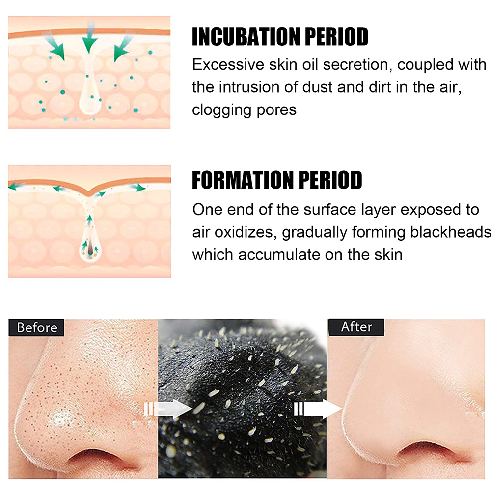 10PCS Unisex Blackhead Remove  - đánh giá và giá Skincare Viral Tiktok