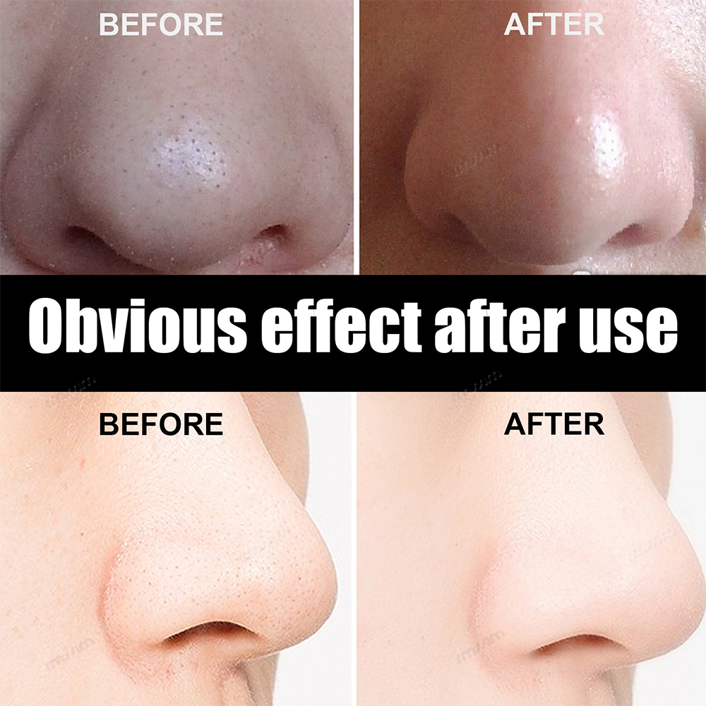 New 10-100pcs Unisex Blackhead - đánh giá và giá Skincare Viral Tiktok